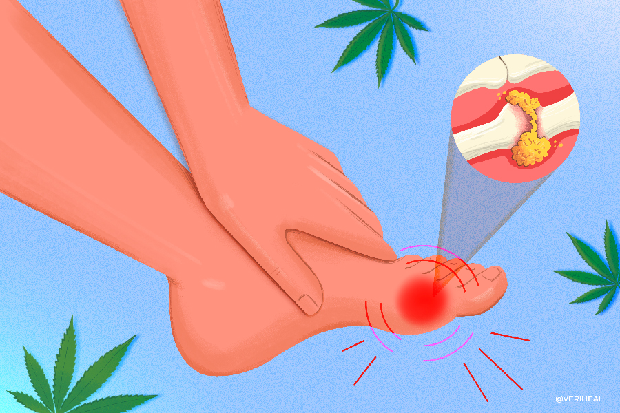 Using Cannabis to Help Treat the Excruciating Symptoms of Gout