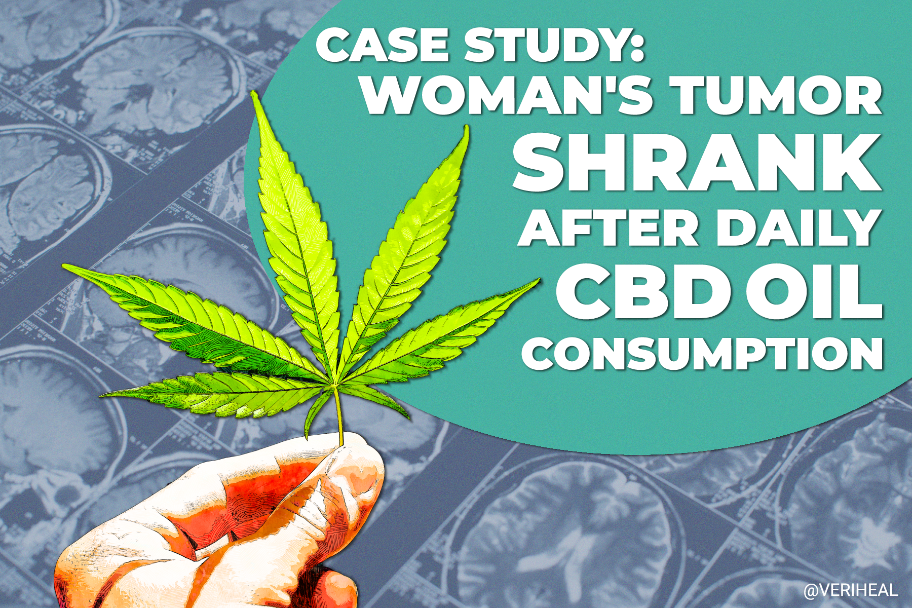 Case Study: Woman’s Tumor Shrank After Daily CBD Oil Consumption Over 2+ Years