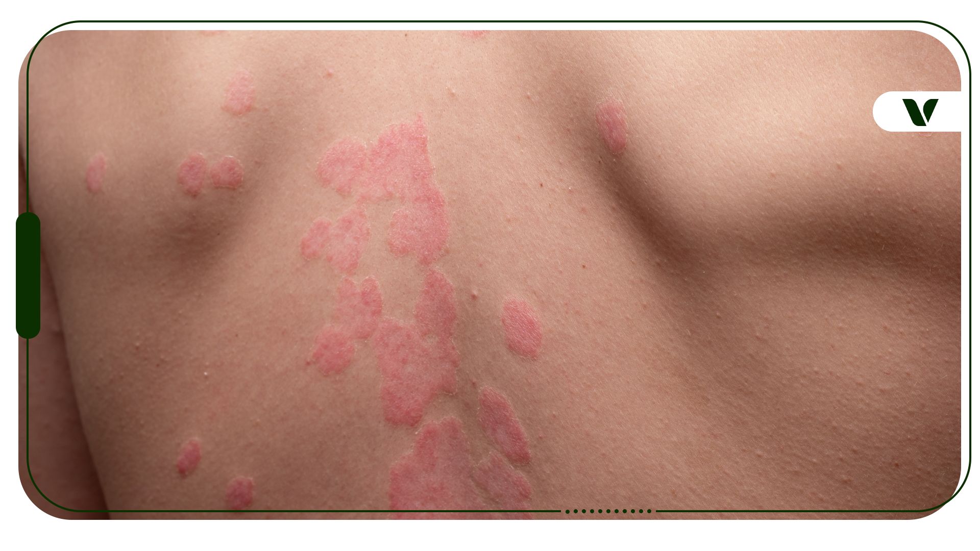 topical cbd for psoriasis