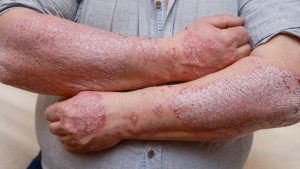 Psoriasis skin with red wounds. Male arms with cracked, hard, flaky skin. 