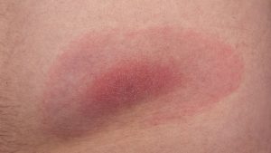 skin inflammation from a tick bite
