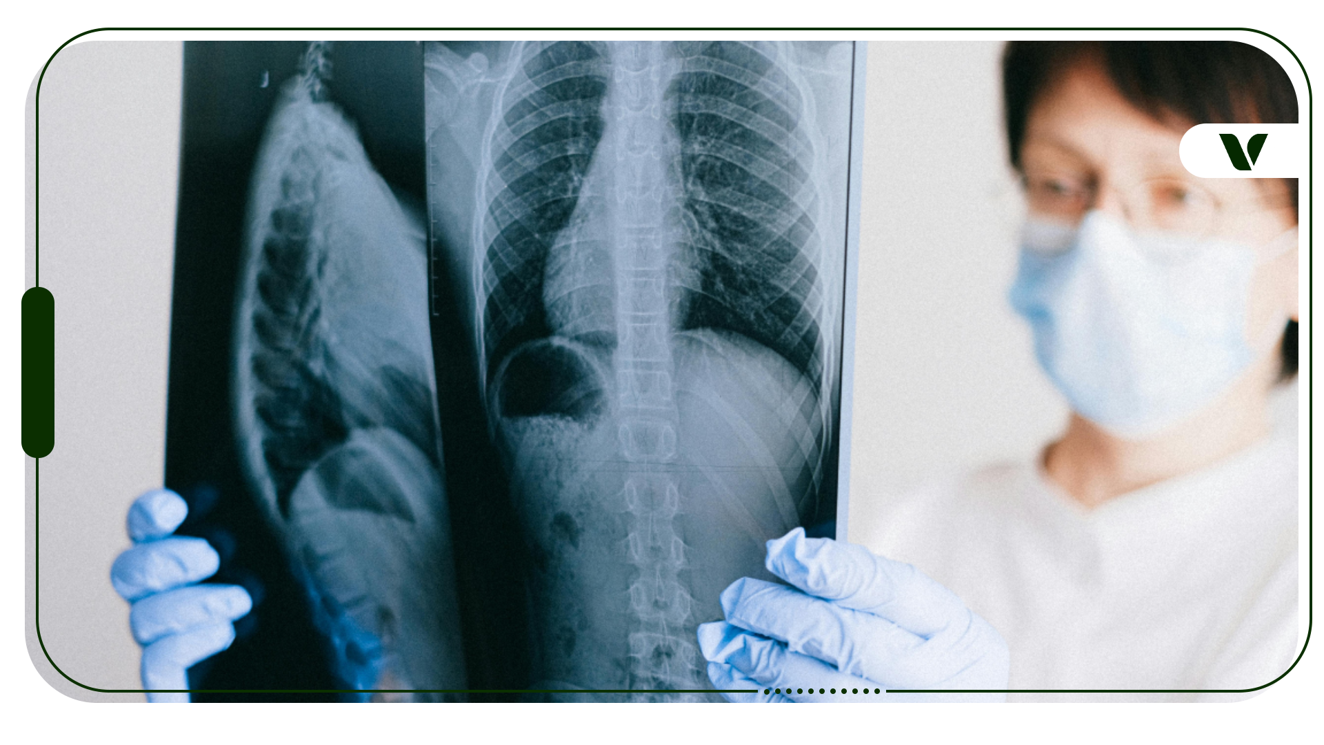 More Non-Smokers are Getting Lung Cancer. How Much Does Cannabis Contribute?