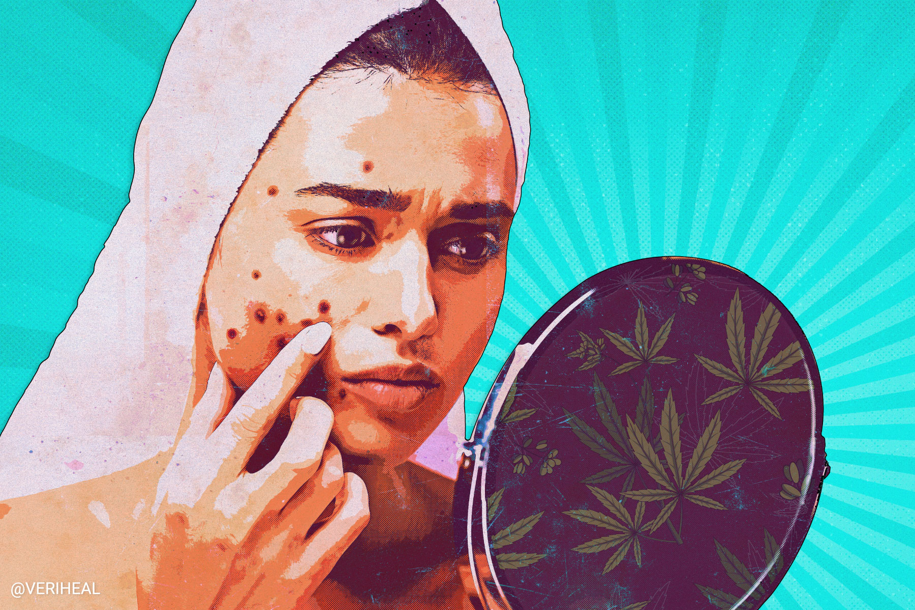 Cannabis and CBD for Acne
