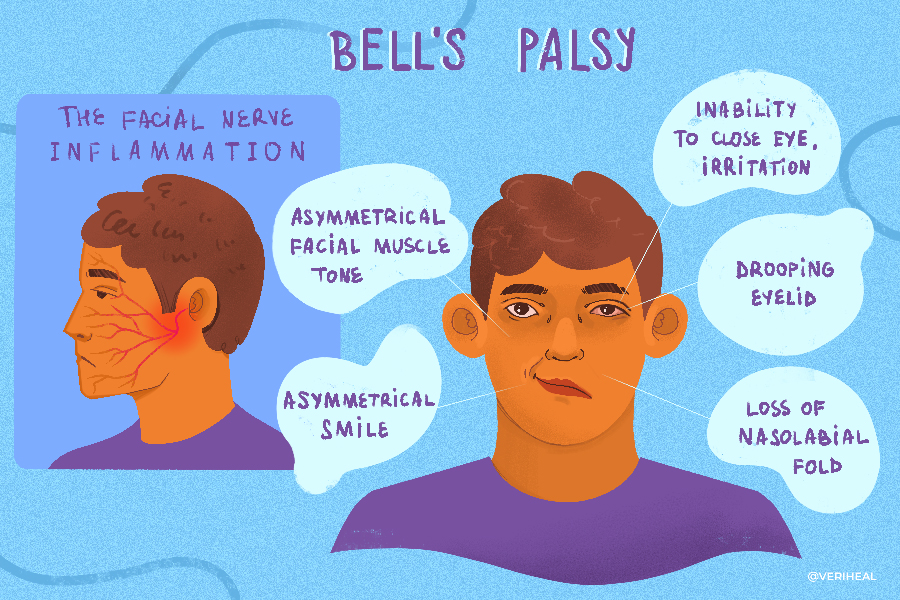 Pharmacological Treatments of Bell's Palsy in Adults: A Systematic