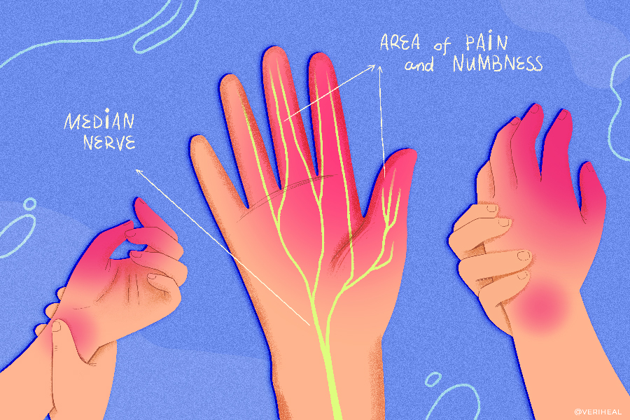Can Marijuana Help Patients Suffering from Carpal Tunnel?