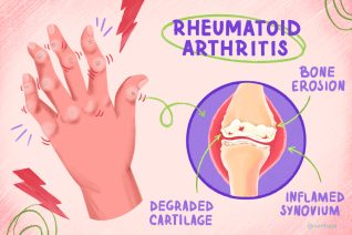 Patients Turn to Medical Marijuana for Rheumatoid Arthritis