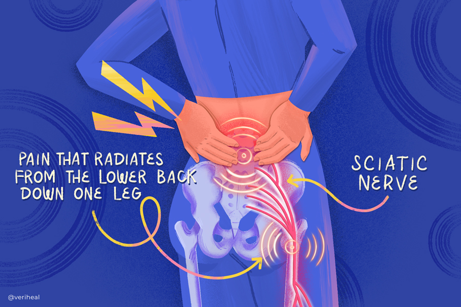 Sciatica Pain Relief - Take pressure off the sciatic nerve