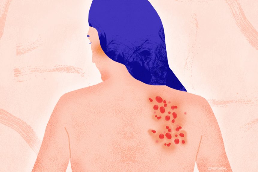 Medical Marijuana for Shingles Postherpetic Neuralgia